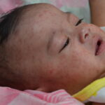 A baby with measles in the Philippines, 2014. CDC Global / Public domain.