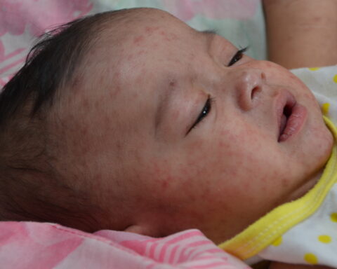 A baby with measles in the Philippines, 2014. CDC Global / Public domain.