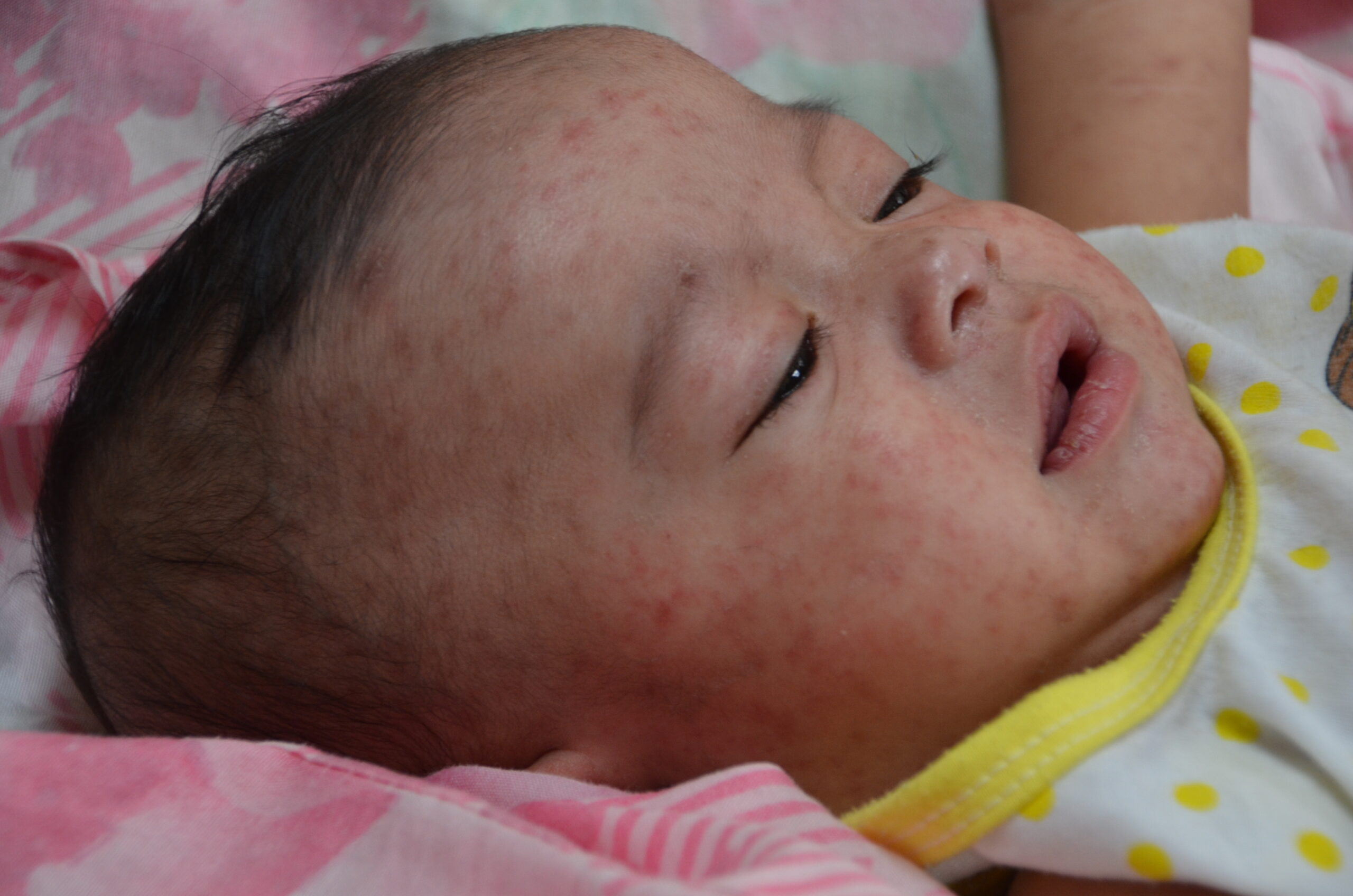 A baby with measles in the Philippines, 2014. CDC Global / Public domain.